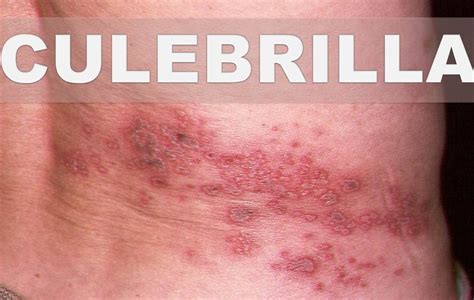 Que es la culebrilla fotos - La culebrilla (también llamada herpes zóster) es un sarpullido doloroso de la piel causada por el mismo virus que causa la varicela. Esta infografía ofrece información …